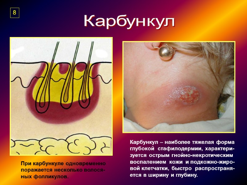 Карбункул Карбункул – наиболее тяжелая форма  глубокой  стафилодермии, характери- зуется острым гнойно-некротическим